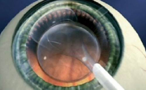 contact lens implant