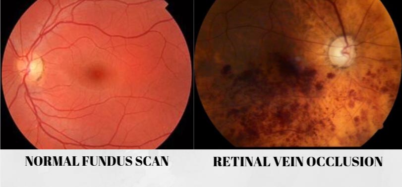 Oklusi vena retina display reeves bed